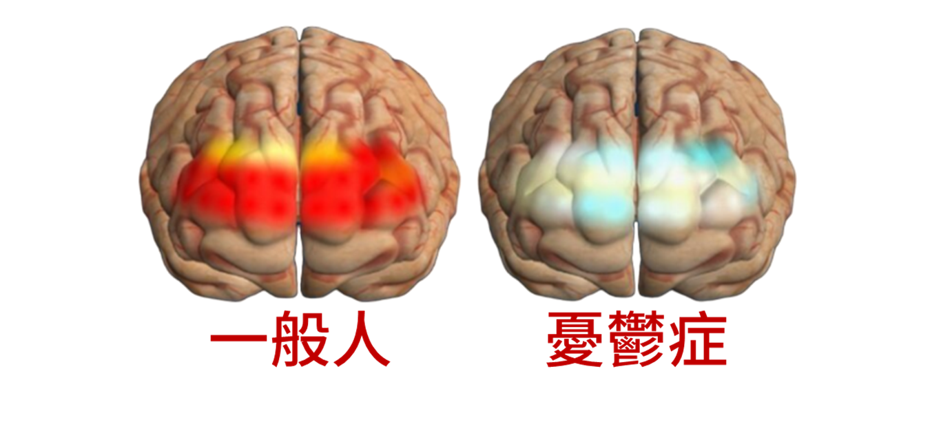 憂鬱症評估與治療新利器 結合近紅外光腦光譜檢測、顱刺激治療效果看得見 憂鬱症評估與治療新利器 結合近紅外光腦光譜檢測、顱刺激治療效果看得見