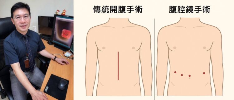 高雄市立大同醫院精準診斷　成功完成高齡胃癌病患微創全胃切除手術